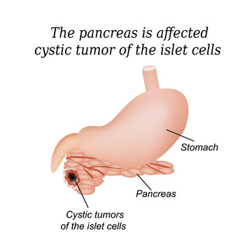 The pancreas is affected cystic tumor of the islet cells