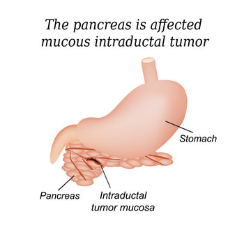 The pancreas is affected mucous intraductal tumor. Vector