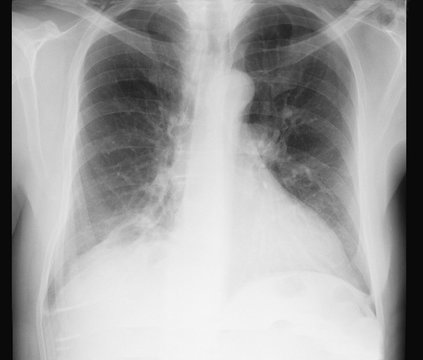 X-ray examination image of chest