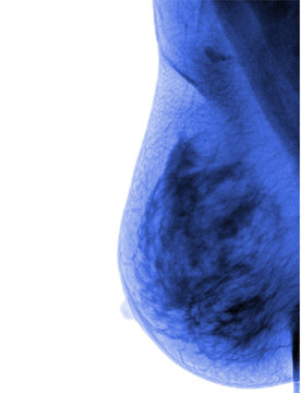 Healthy breast scan X-ray