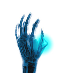 Naklejka premium xray abnormal finger from the side, black background