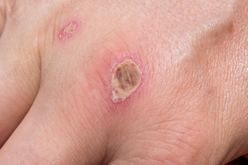 Fototapeta premium wound