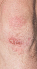 Fototapeta premium wound