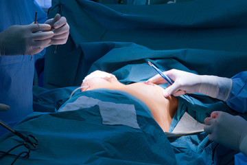 Breast augmentation - obrazy, fototapety, plakaty