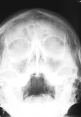 X-ray of human skull, closeup