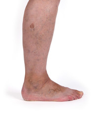 Old woman with varicose veins