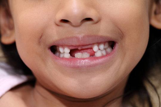 Young girl with missing front tooth