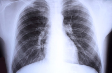 X-ray