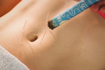 Young woman getting acupuncture treatment