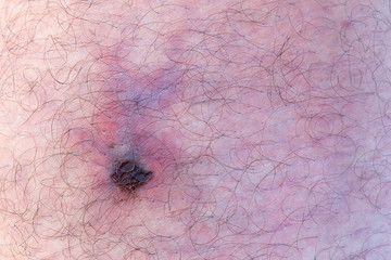 The sting of a loxosceles refunses spider.