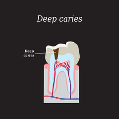 Deep tooth decay. Vector illustration on a black background