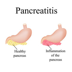 Obraz premium Inflammation of the pancreas. Pancreatitis. Vector illustration