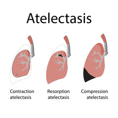 atelectasis. vector illustration of lung disease