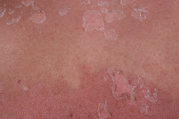 Sunburn skin