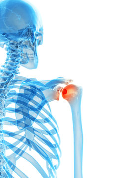 medically accurate illustration - painful shoulder