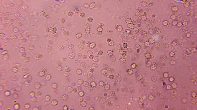 Blood Sample With Burr Cells and Red Cells 600x Magnification. 