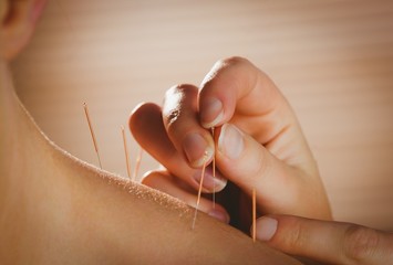 Young woman getting acupuncture treatment - obrazy, fototapety, plakaty