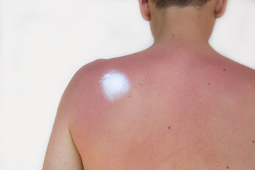 Sonnenbrand und Sonnencreme auf der Schulter eines Mannes