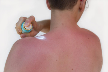Mann sprüht sich Sonnenmilch auf Sonnenbrand am Rücken