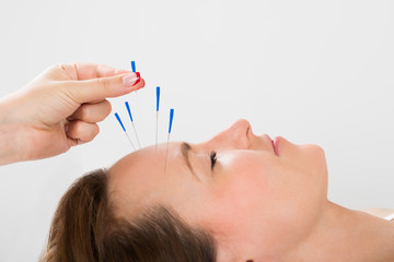 Young Woman Receiving Acupuncture Treatment - obrazy, fototapety, plakaty