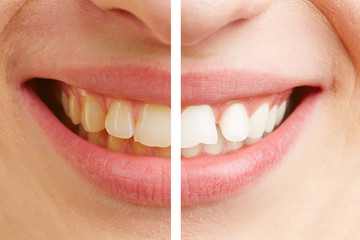 Vorher nachher Vergleich von Zähnen beim Bleaching