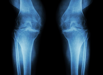 Osteoarthritis Knee ( OA Knee ) ( Film x-ray both knee with arthritis of knee joint : narrow knee joint space ) ( Medical and Science background )