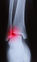 x-ray image of human foot joint , back view