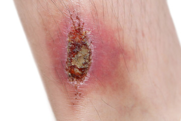 wounded leg in white background