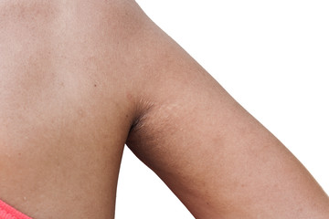 scratch mark and wrinkle of armpit
