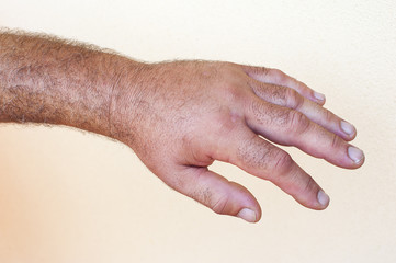 Mosquito bite