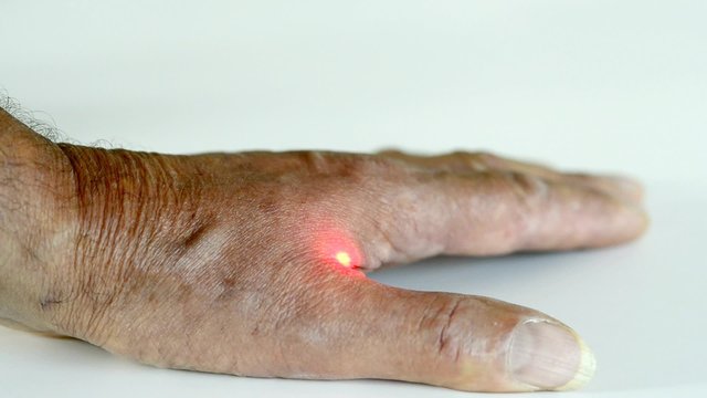 Laser-Akupunktur an menschlicher Hand
