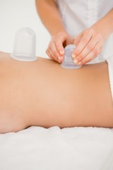 Woman with vacuum cups on her back