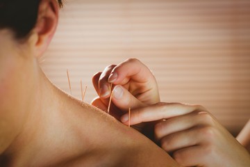 Young woman getting acupuncture treatment - obrazy, fototapety, plakaty