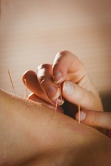 Young woman getting acupuncture treatment - obrazy, fototapety, plakaty