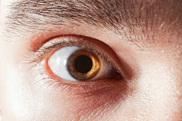 male eye with mydriatic pupil