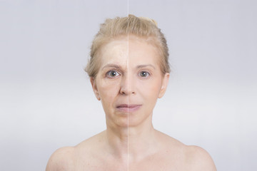 Woman before and after skin treatment 