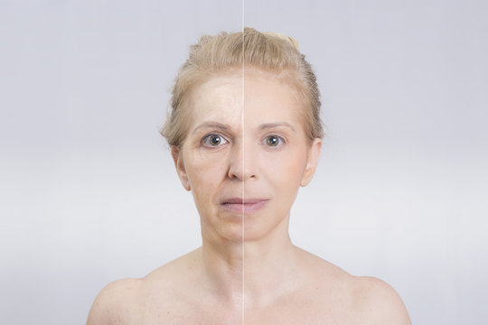 Как выглядит сахарное лицо фото Botox Senior Изображения: просматривайте стоковые фотографии, векторные изображе