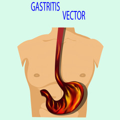 stomach, fire, gastritis