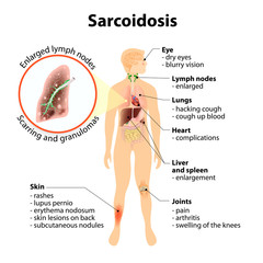 Sarcoidosis signs and symptoms