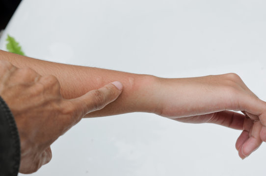 Mosquito bites on right arm.