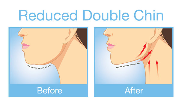 Illustration before and after reduce a double chin. Look firming up in after image.