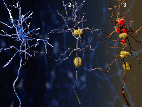 3 Phasen der Alzheimer-Krankheit:
1. Gesundes Neuron, 2. Neuron mit Amyloid-Plaques (gelb), 3. Totes Neuron wird Microglia-Zellen (rot) zersetzt.