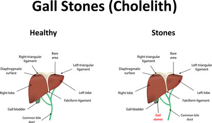 Obraz premium Gall Stones