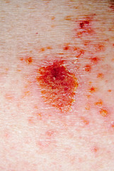 basal cell skin cancer being treated with fluorouracil topical m