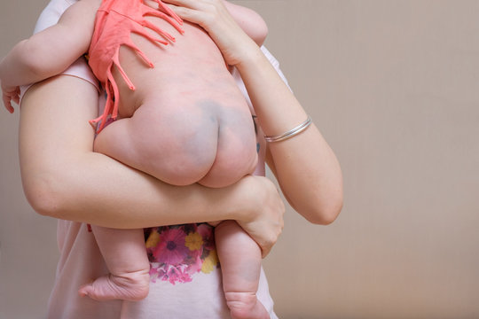 Birthmark on Asian baby girl's bottom