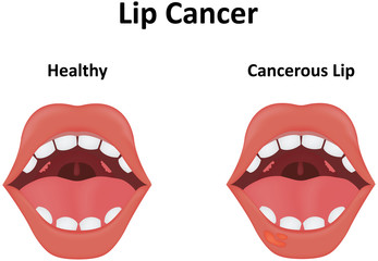 Lip Cancer Illustration
