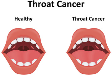Fototapeta premium Throat Cancer Illustration