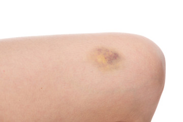 Bruise on wounded woman leg skin