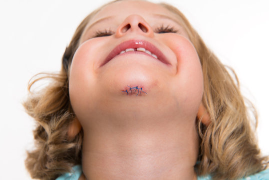 little white girl with wound in her face