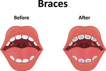 Braces Illustration